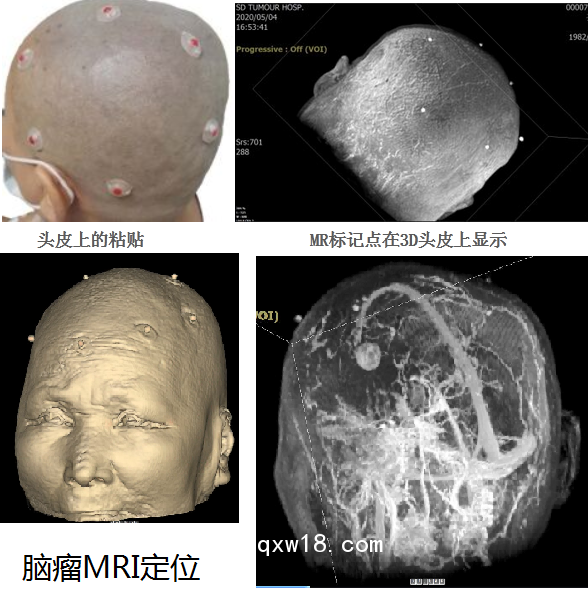 醫(yī)學(xué)圖像體外定位貼（MK⊙MR）