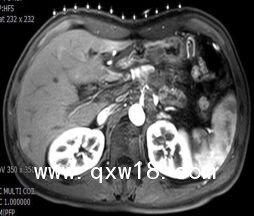 醫(yī)學(xué)圖像體外定位貼（MK#MR型，MR引導(dǎo)定位柵）