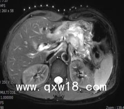 醫(yī)學(xué)圖像體外定位貼（MK#MR型，MR引導(dǎo)定位柵）