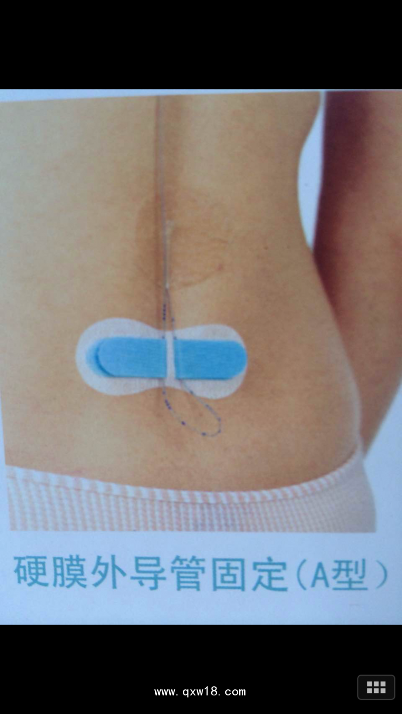 一次性使用無(wú)菌敷貼A型1號(hào)