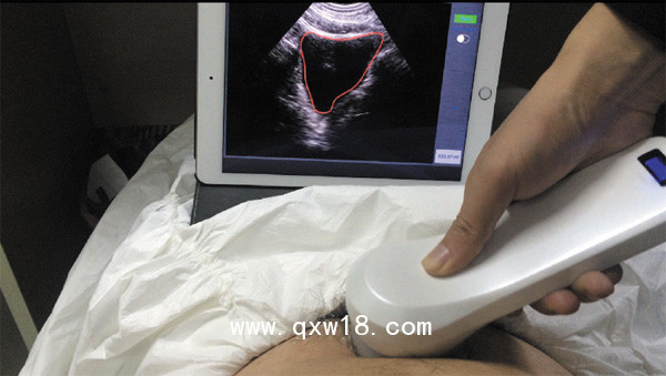 SONOSTAR四維掃描無(wú)線探頭式膀胱儀