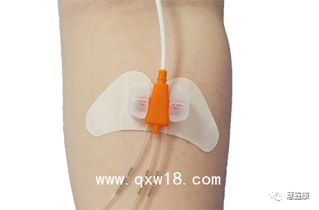 中心靜脈導(dǎo)管固定器-思樂(lè)扣