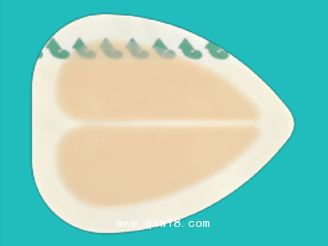 一次性使用無菌敷貼（壓瘡褥瘡貼）