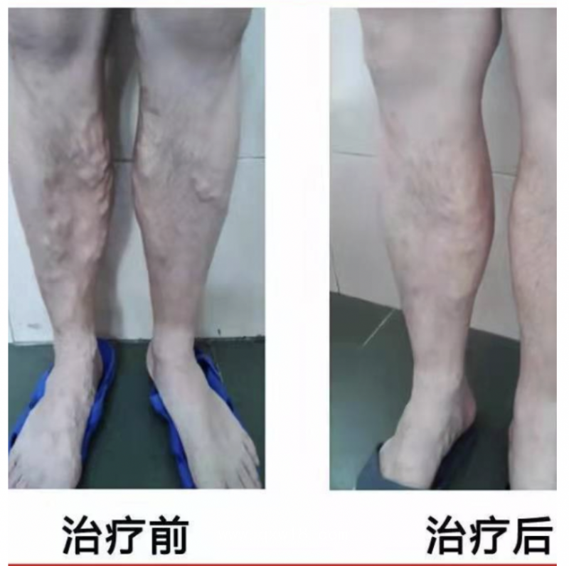 下肢靜脈曲張消融導(dǎo)管