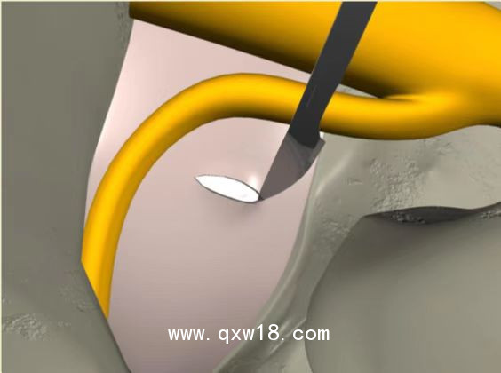 一次性纖維環(huán)縫合器使用意義 優(yōu)劣勢