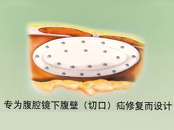 巴德切口疝補(bǔ)片