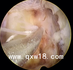 一次性纖維環(huán)縫合器