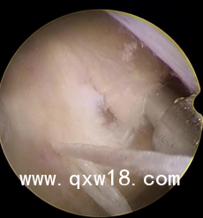 骨科耗材一次性纖維環(huán)縫合手術