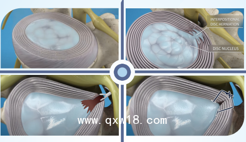 一次性使用纖維環(huán)縫合器PPT課件