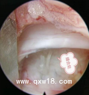 國產(chǎn)骨科高值耗材非帶量一次性纖維環(huán)縫合器