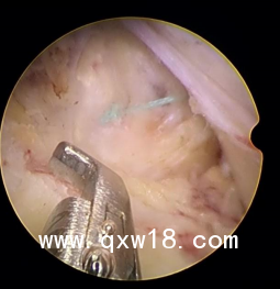 椎間孔鏡手術(shù)專用帶量耗材纖維環(huán)縫合器