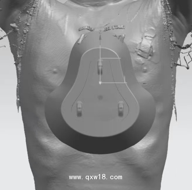 漏斗胸矯正器，負(fù)壓吸盤