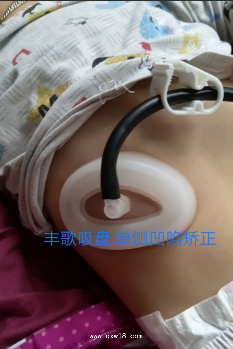 漏斗胸矯正器，負(fù)壓吸盤