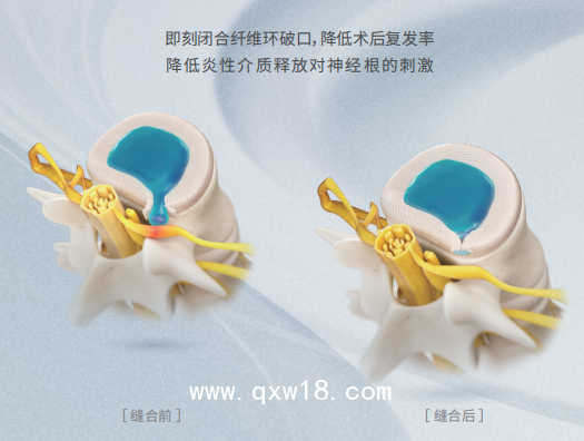 廣東省骨科高值耗材一次性纖維環(huán)縫合器