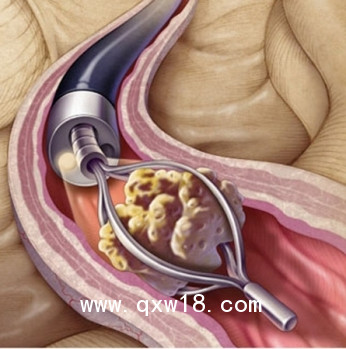 激光治療機(jī) JRHI鈥激光 泌尿系統(tǒng)結(jié)石粉碎機(jī) 普美康