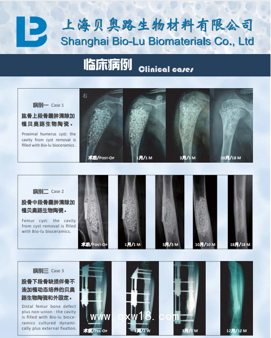 國產(chǎn)貝奧路多孔生物陶瓷 骨科 骨缺損 脊柱融合 骨腫瘤 骨不連 關(guān)節(jié)融合