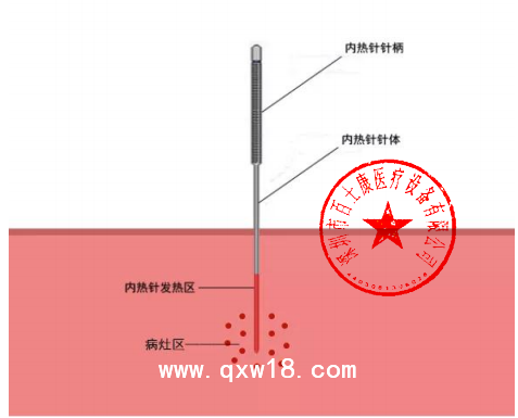 百士康廠家 內(nèi)熱針治療儀 內(nèi)熱針 使用環(huán)境要求