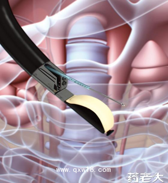 王氏TBNA活檢穿刺針