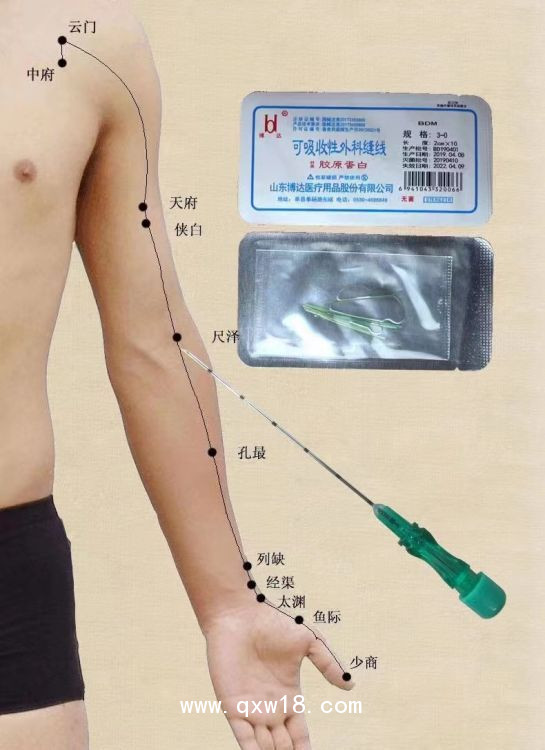 一次性使用埋線針