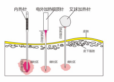 內(nèi)熱針針具、銀質(zhì)針設(shè)備 內(nèi)熱針治療儀