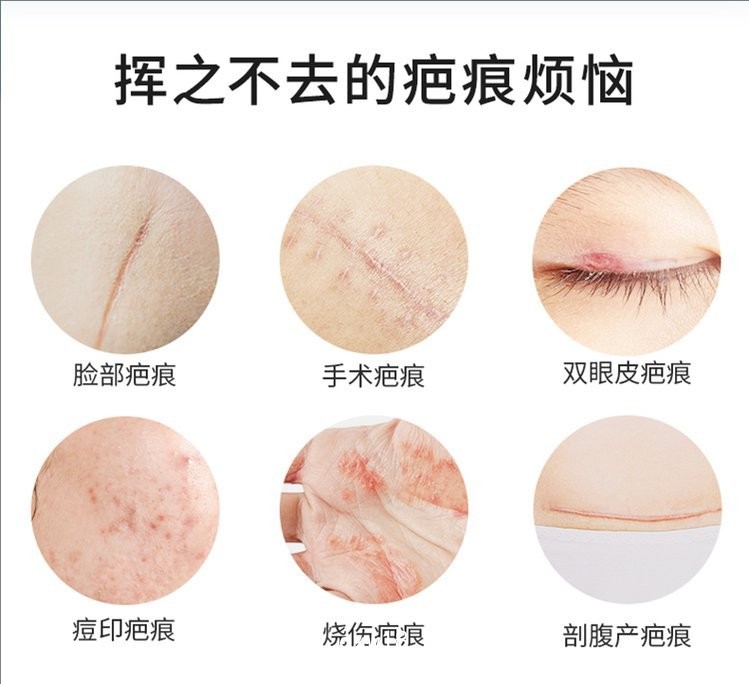 疤痕貼 疤痕凝膠生產(chǎn)廠家—全國(guó)招商承接代加工—可來樣加工按需定制