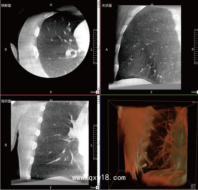 呼吸介入C型臂臨床應(yīng)用-普愛醫(yī)療三維C型臂CT