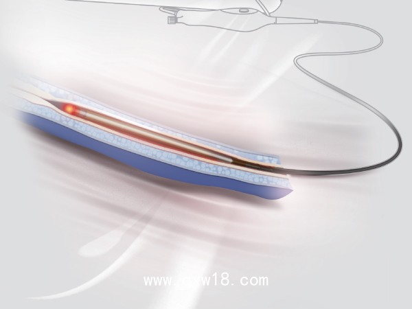 一次性使用靜脈腔內射頻閉合導管