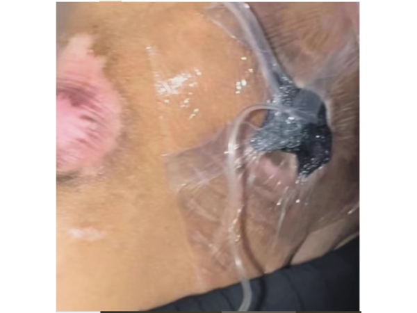 醫(yī)用透明敷貼20x30cm封閉負(fù)壓引流VSD 護(hù)創(chuàng)無菌敷貼膜vsd