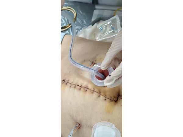 一次性使用肛腸引流管套件