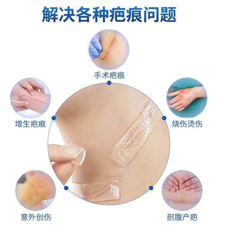疤痕貼二類器械臨床掛網剖腹產疤痕新舊疤痕貼
