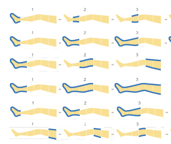 空氣波壓力治療儀