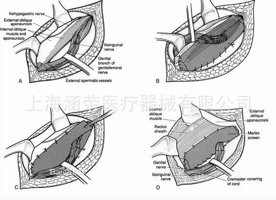 疝修補(bǔ)手術(shù)示意圖
