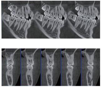 口腔CBCT 多平面組合重建 口腔CBCT 多平面組合重建