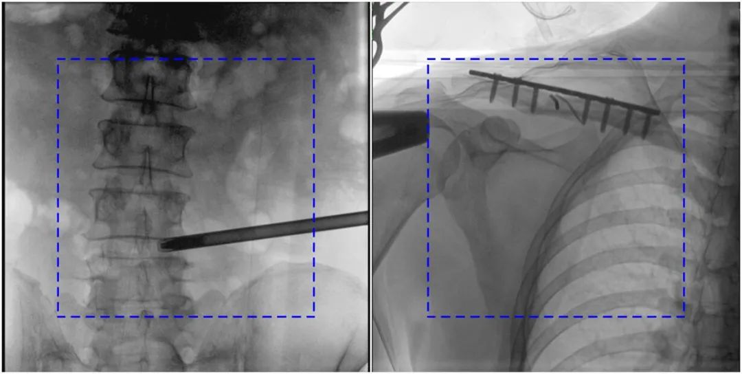 大平板一體式C形臂圖像對比 大平板一體式C形臂圖像對比