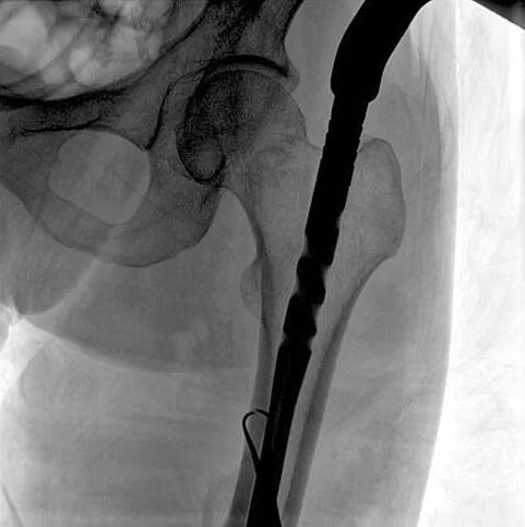 大平板一體式C形臂成像面積 大平板一體式C形臂成像面積