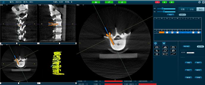 骨科機(jī)器人準(zhǔn)確定位 骨科機(jī)器人準(zhǔn)確定位
