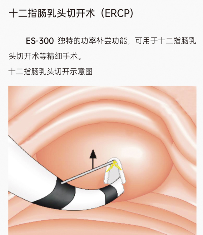 氬氣刀十二指腸乳頭切開(kāi)