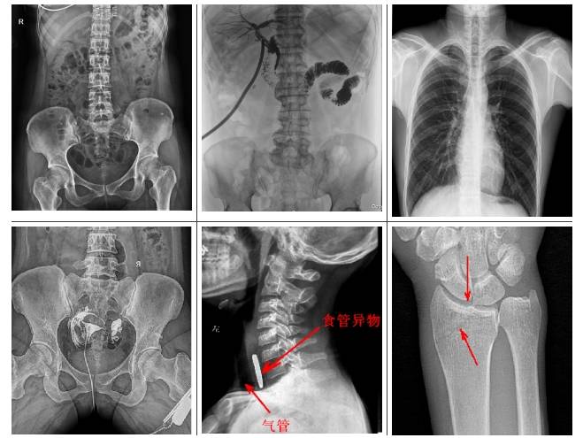 懸吊雙板DR臨床影像