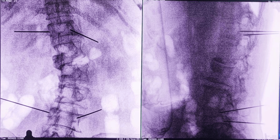 骨科手術(shù)機器人術(shù)后圖像