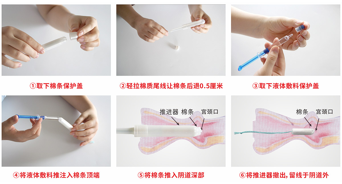 宮腔填塞吸附栓、陰道填塞吸附栓、陰道填塞止血吸附栓